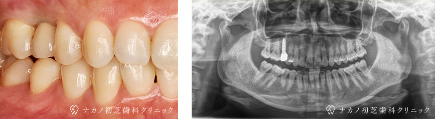 インプラント症例