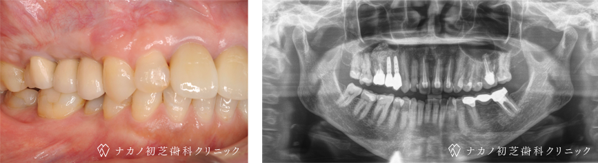 インプラント症例