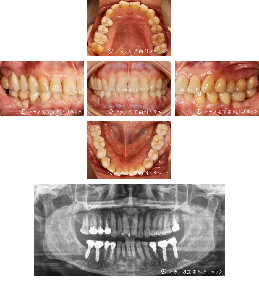 インプラント症例