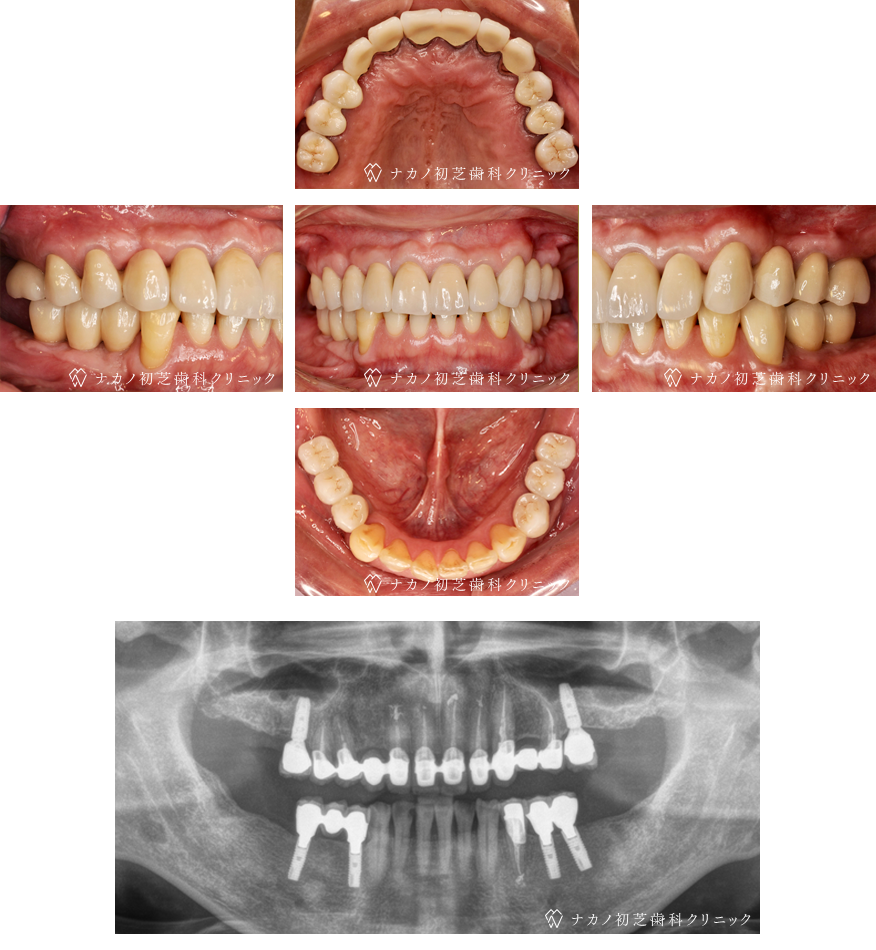 インプラント症例