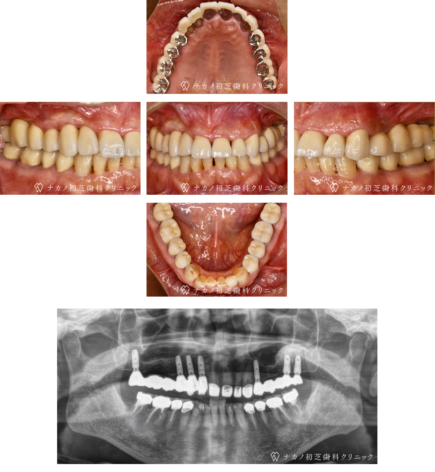 インプラント症例