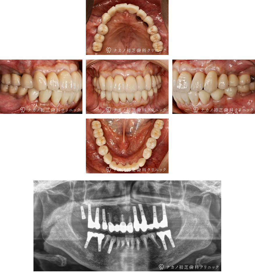 インプラント症例