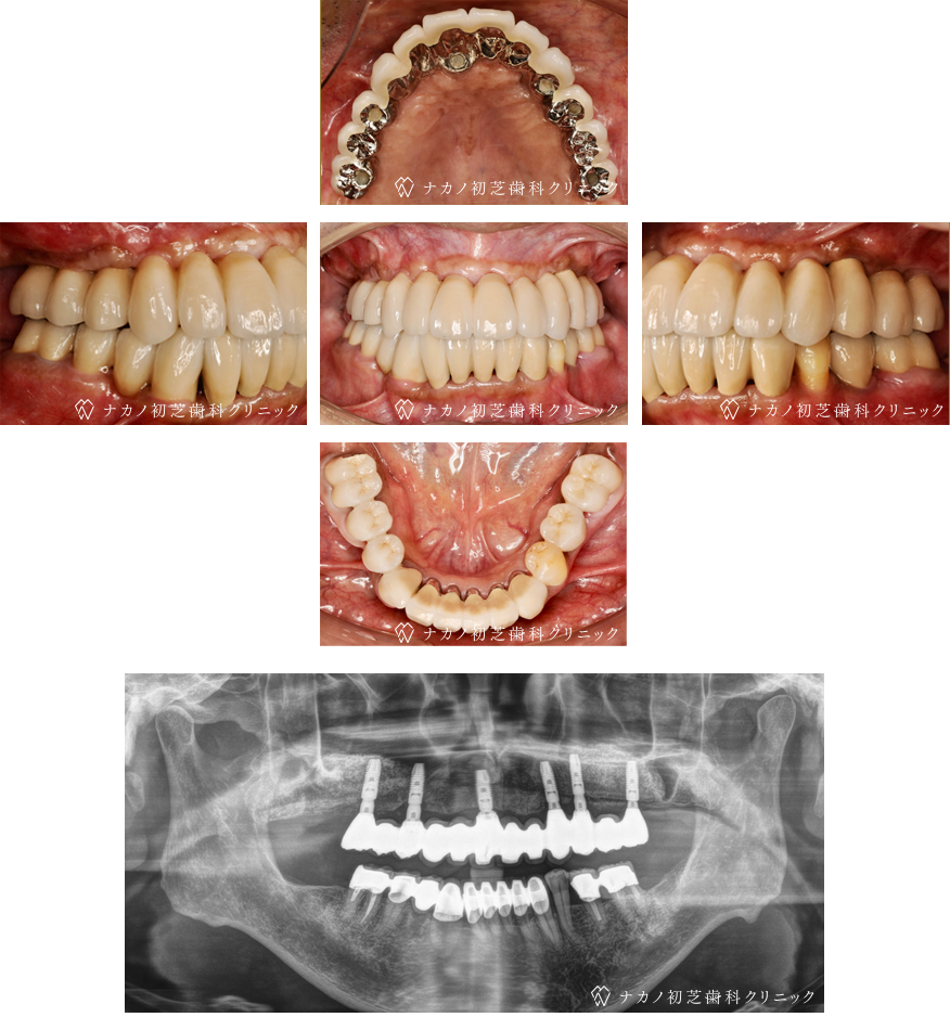 インプラント症例