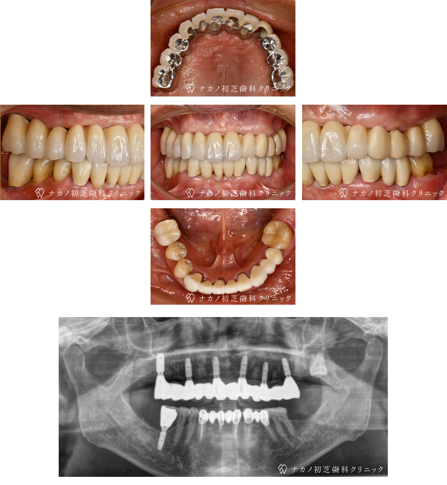 インプラント症例