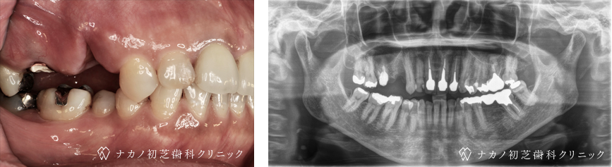 インプラント症例