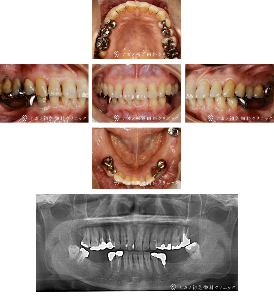 インプラント症例