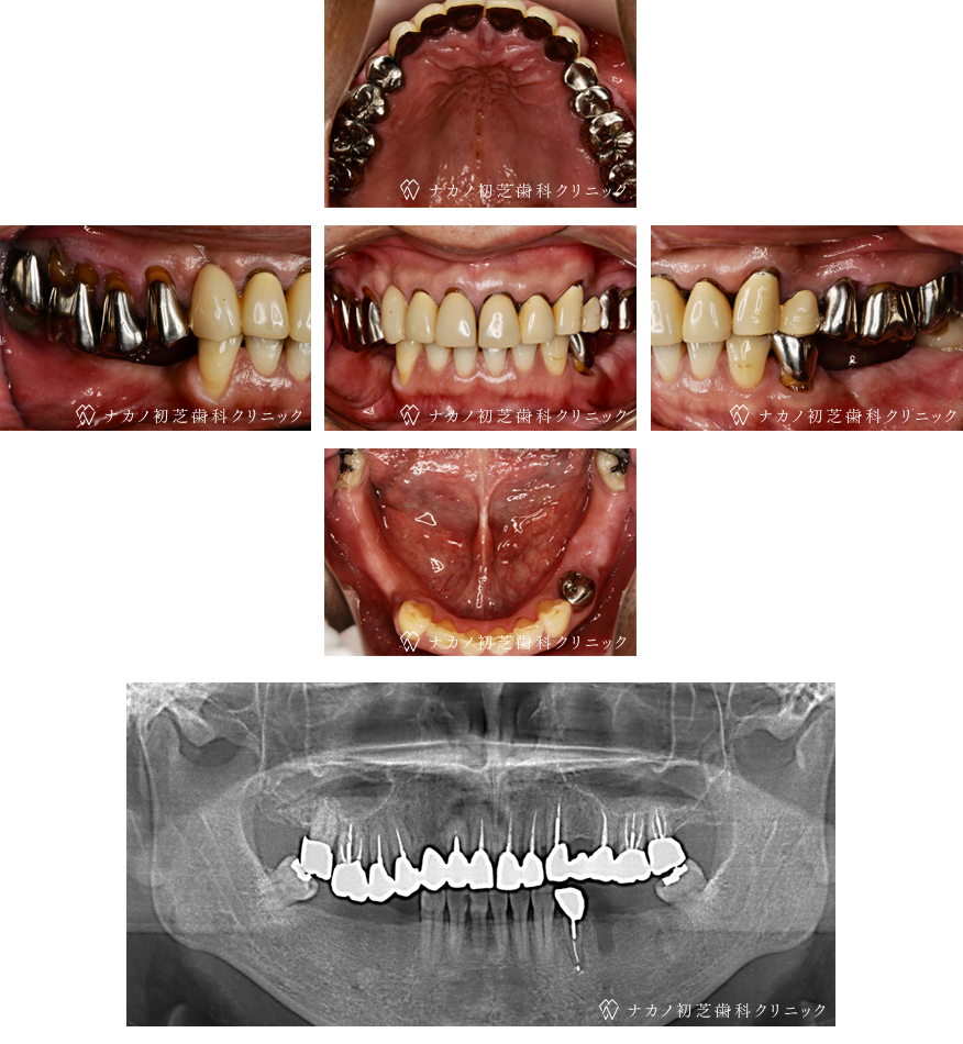 インプラント症例