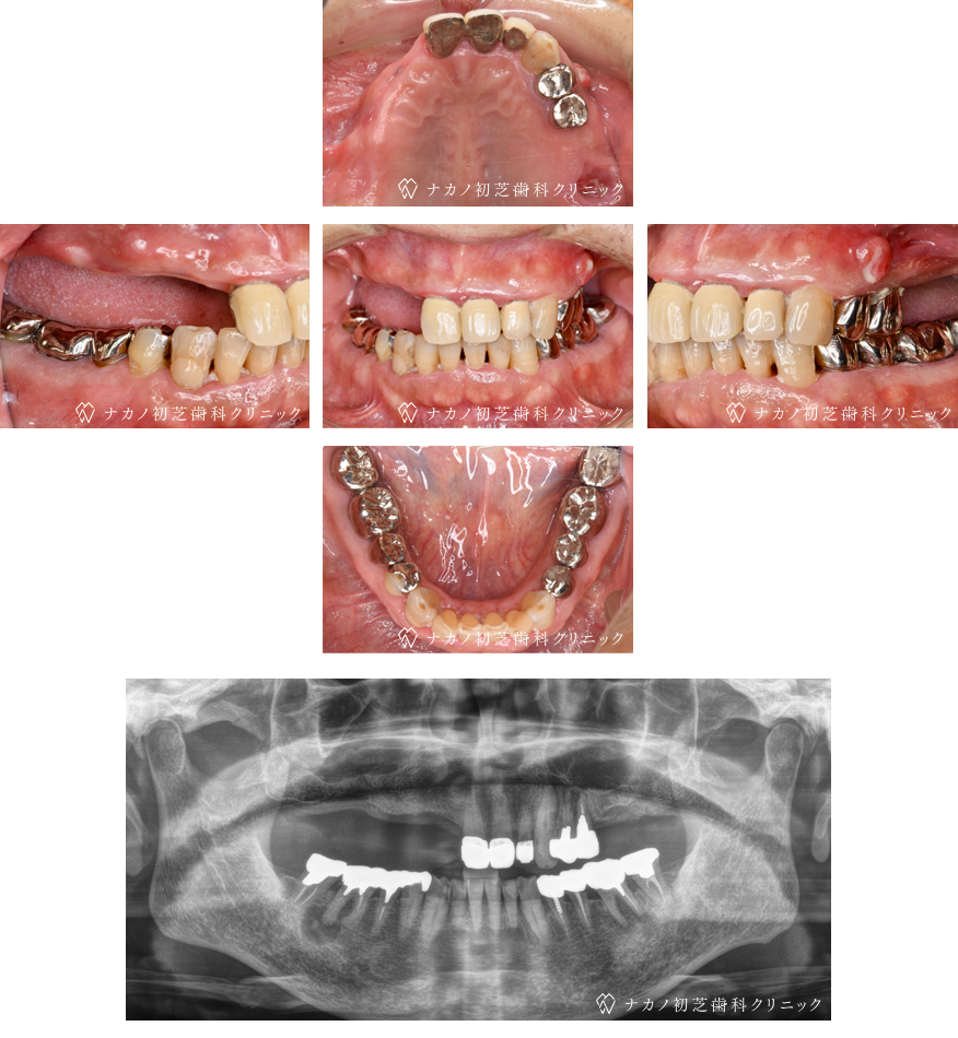 インプラント症例