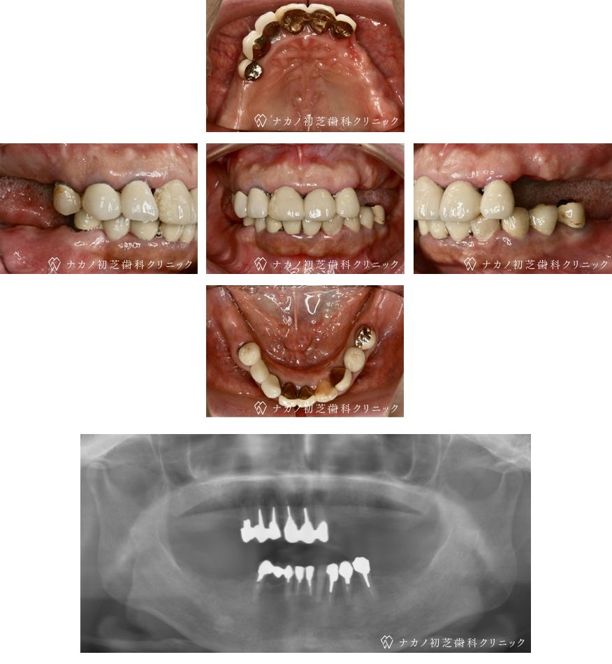 インプラント症例