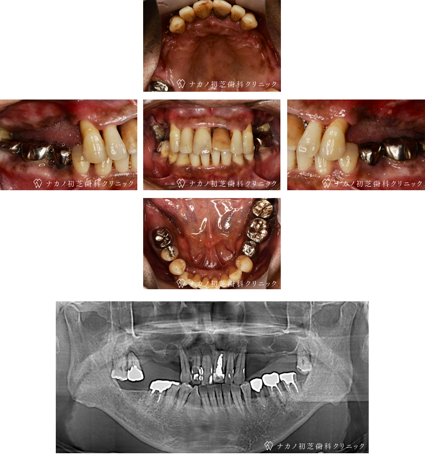 インプラント症例