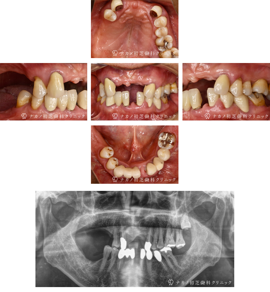 インプラント症例