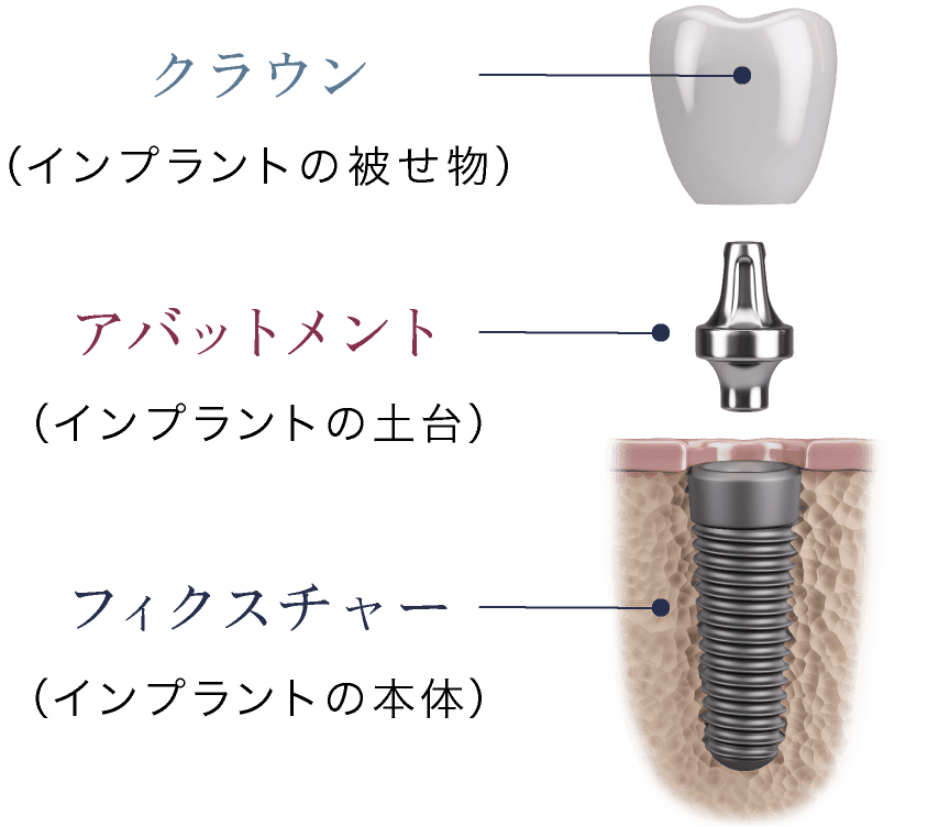 クラウン（インプラントの被せ物）、アバットメント（インプラントの土台）、フィクスチャー（インプラントの本体）