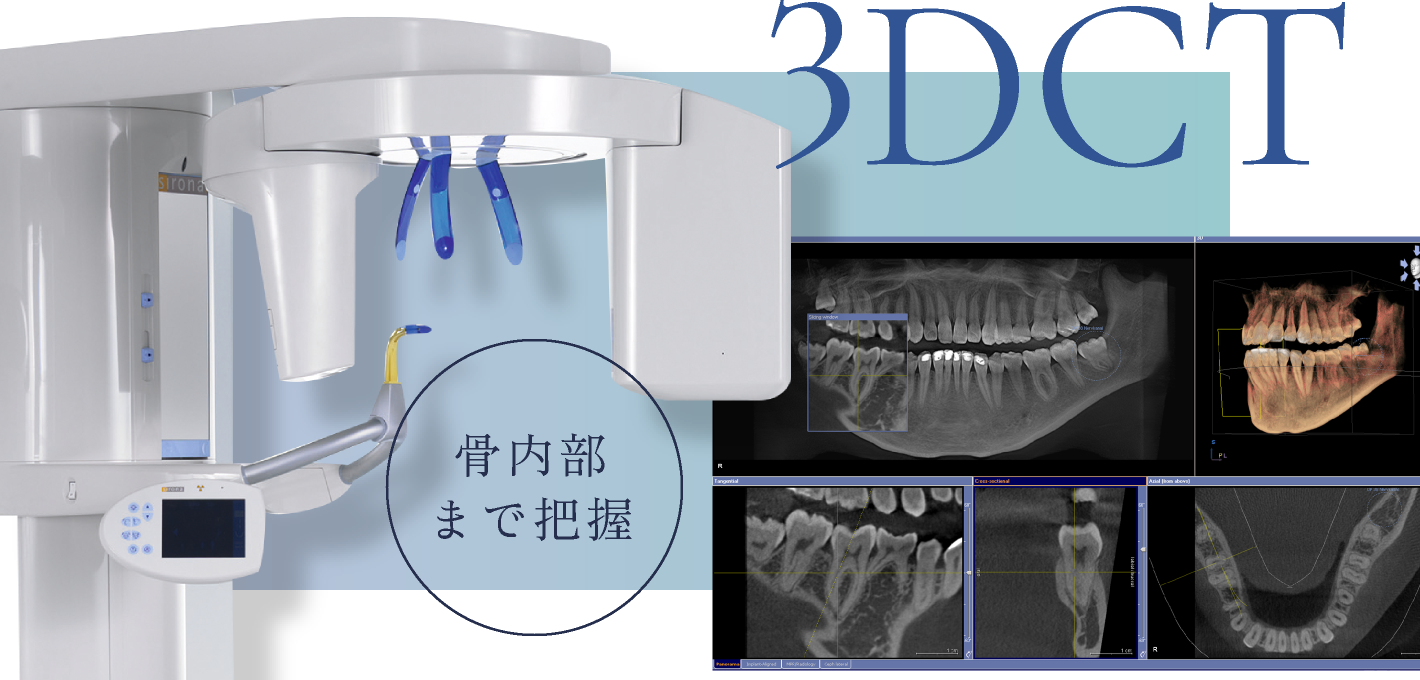 3DCTで骨内部まで把握
