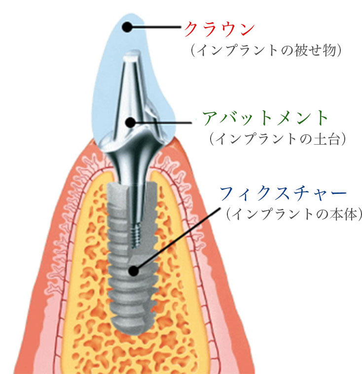 インプラント構造